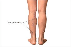Varicose Veins Exercise Guide: Best Workouts for Healthy Legs